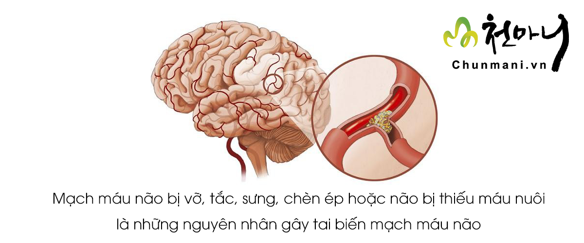 Nguyên nhân gây tai biến mạch máu não